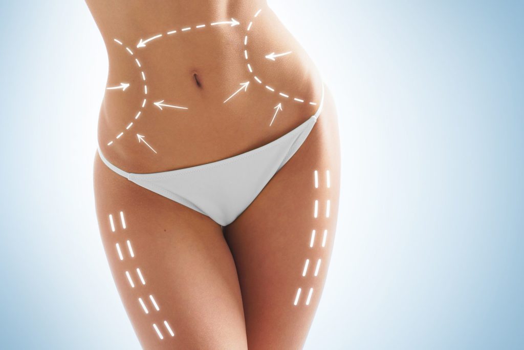 What Is the Difference Between Liposuction and A Tummy Tuck?