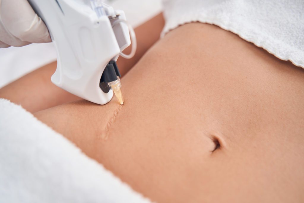 Woman getting treatment on her stomach scar