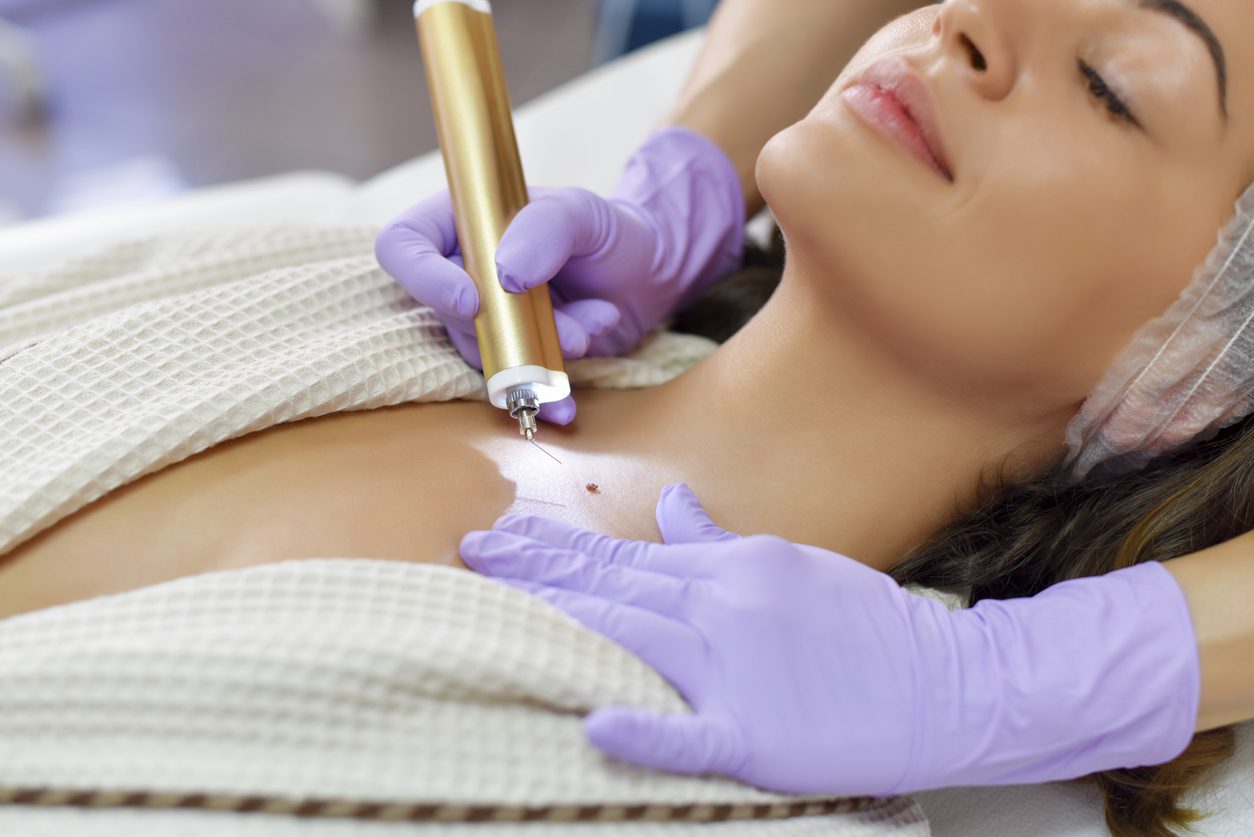 A woman lying down with eyes closed, receiving a cosmetic procedure. She wears a white gown and a headband. The practitioner in purple gloves holds a golden tool near her chest, with a small dark mark being treated.
