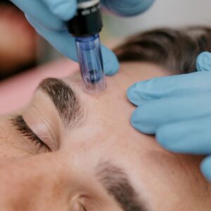 Microneedling on forehead with Exosome Therapy