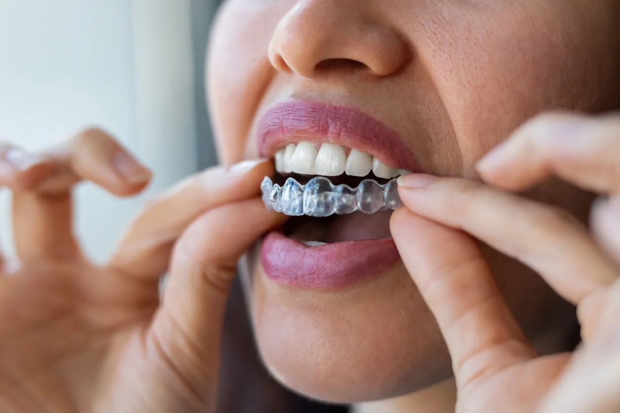 Gros plan sur une personne qui pose un aligneur Invisalign sur ses dents supérieures. L'attention se porte sur sa bouche et ses mains tandis qu'elle place délicatement le dispositif en plastique transparent, illustrant ainsi les soins dentaires.