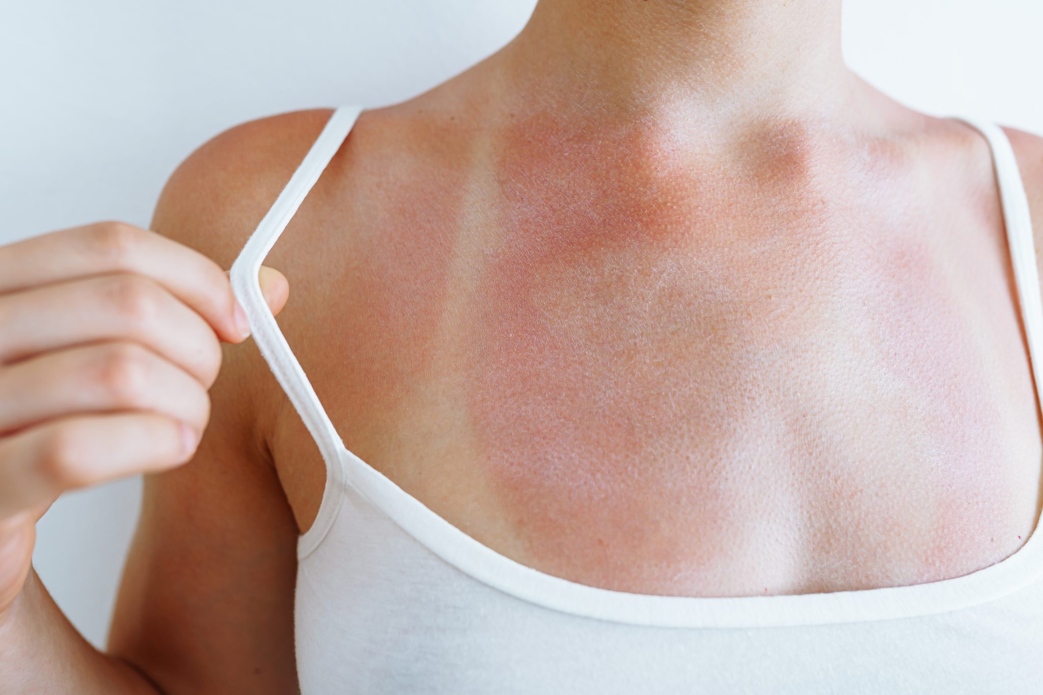 A person displays sunburned skin on their chest, revealing clear tan lines from a tank top. The red, irritated areas highlight the extent of sun damage, contrasting sharply with patches of original skin tone. They adjust the strap of their white tank top, mindful of the discomfort.