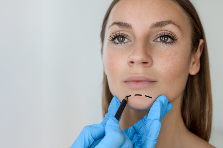 Un chirurgien dessine les contours d'un lifting sur le visage d'une femme avant une consultation pour un mini-lifting.