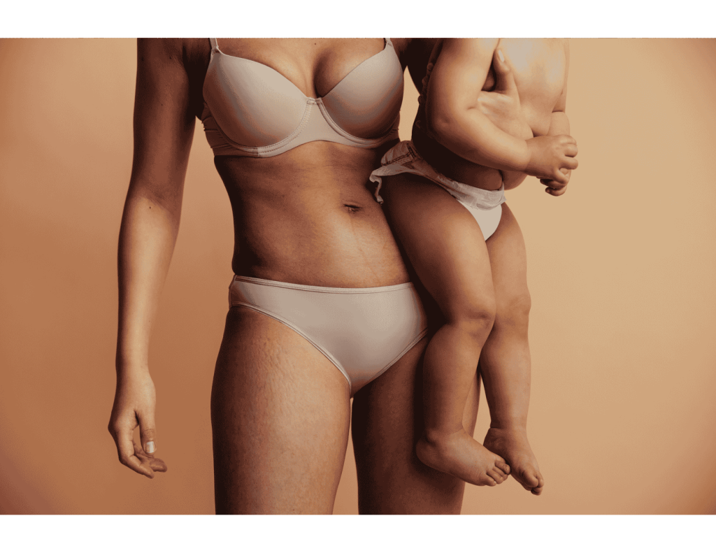 Postpartum body before a mommy makeover: mother holding baby, close-up torso showing stretch marks and skin laxity.