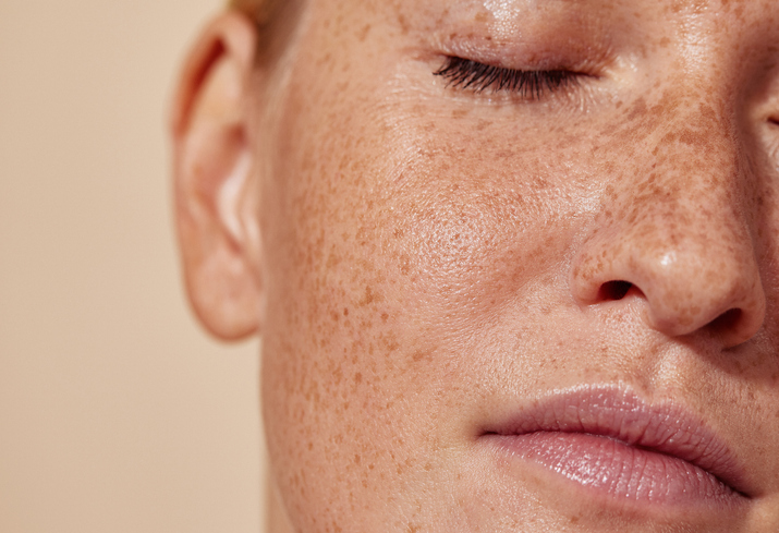 Close-up of a freckled woman’s face with eyes closed, showing natural skin texture and calm expression.