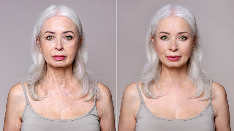Side-by-side before and after of a mature woman showing subtle cheek and jawline improvement following a thread lift procedure.